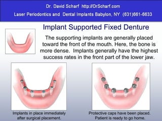 Implant Supported Fixed Denture The supporting implants are generally placed toward the front of the mouth. Here, the bone is more dense.  Implants generally have the highest success rates in the front part of the lower jaw. Implants in place immediately after surgical placement. Protective caps have been placed.  Patient is ready to go home. 