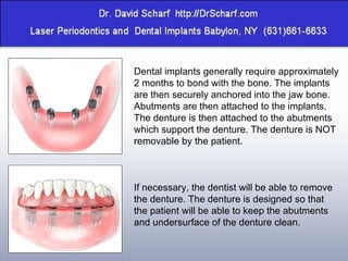 Dental implants generally require approximately 2 months to bond with the bone. The implants are then securely anchored into the jaw bone.  Abutments are then attached to the implants. The denture is then attached to the abutments which support the denture. The denture is NOT removable by the patient. If necessary, the dentist will be able to remove the denture. The denture is designed so that the patient will be able to keep the abutments and undersurface of the denture clean. 