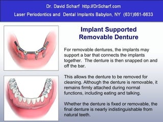 Implant Supported Removable Denture For removable dentures, the implants may support a bar that connects the implants together.  The denture is then snapped on and off the bar.  This allows the denture to be removed for cleaning. Although the denture is removable, it remains firmly attached during normal functions, including eating and talking. Whether the denture is fixed or removable, the final denture is nearly indistinguishable from natural teeth. 