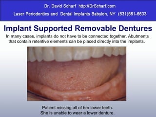 Implant Supported Removable Dentures In many cases, implants do not have to be connected together. Abutments that contain retentive elements can be placed directly into the implants.  Patient missing all of her lower teeth. She is unable to wear a lower denture. 