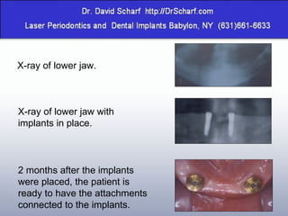X-ray of lower jaw. X-ray of lower jaw with implants in place. 2 months after the implants were placed, the patient is ready to have the attachments connected to the implants. 