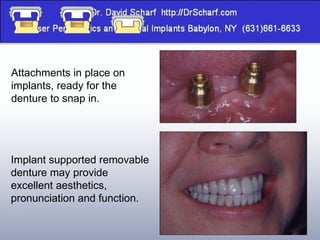 Attachments in place on implants, ready for the denture to snap in. Implant supported removable denture may provide excellent aesthetics, pronunciation and function. 