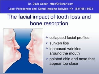 The facial impact of tooth loss and bone resorption collapsed facial profiles sunken lips increased wrinkles  around the mouth pointed chin and nose that appear too close 