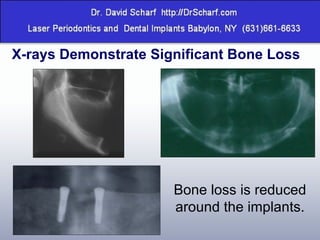 X-rays Demonstrate Significant Bone Loss Bone loss is reduced around the implants. 