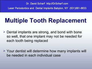 Multiple Tooth Replacement Dental implants are strong, and bond with bone so well, that one implant may not be needed for each tooth being replaced Your dentist will determine how many implants will be needed in each individual case 