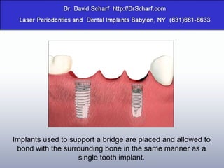 Implants used to support a bridge are placed and allowed to bond with the surrounding bone in the same manner as a single tooth implant. 