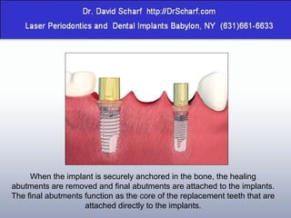 When the implant is securely anchored in the bone, the healing abutments are removed and final abutments are attached to the implants. The final abutments function as the core of the replacement teeth that are attached directly to the implants. 