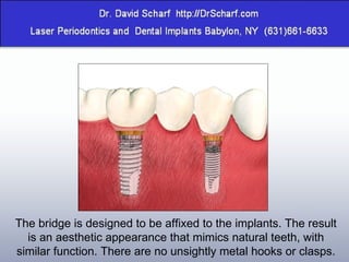 The bridge is designed to be affixed to the implants. The result is an aesthetic appearance that mimics natural teeth, with similar function. There are no unsightly metal hooks or clasps. 
