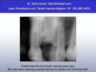 Patient lost this front tooth several years ago. She has been wearing a partial denture to replace her missing tooth. 