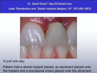 In just one day: Patient had a dental implant placed, an abutment placed onto the implant and a provisional crown placed onto the abutment. 