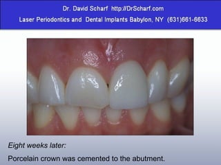 Eight weeks later: Porcelain crown was cemented to the abutment. 