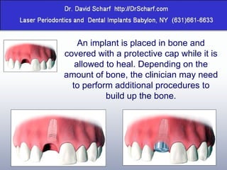 An implant is placed in bone and covered with a protective cap while it is allowed to heal. Depending on the amount of bone, the clinician may need to perform additional procedures to build up the bone. 