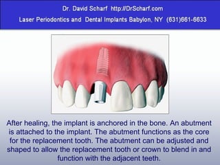 After healing, the implant is anchored in the bone. An abutment is attached to the implant. The abutment functions as the core for the replacement tooth. The abutment can be adjusted and shaped to allow the replacement tooth or crown to blend in and function with the adjacent teeth. 