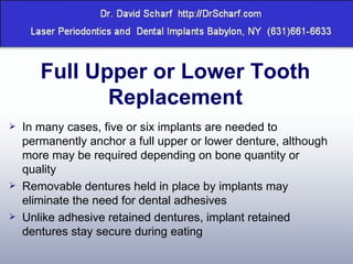 Full Upper or Lower Tooth Replacement In many cases, five or six implants are needed to permanently anchor a full upper or lower denture, although more may be required depending on bone quantity or quality  Removable dentures held in place by implants may eliminate the need for dental adhesives Unlike adhesive retained dentures, implant retained dentures stay secure during eating  