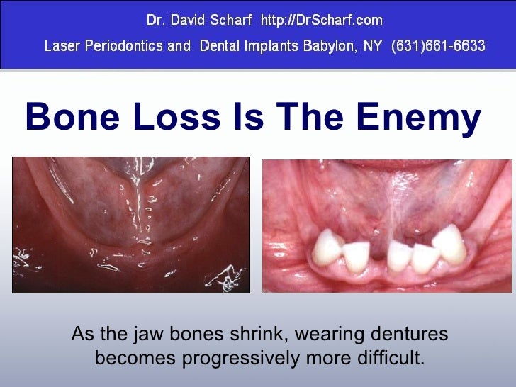 Secure Denture Adhesive >> Replacing Missing Teeth with Dental Implants on Long Island, Dental i… Secure Denture Adhesive >> Replacing Missing Teeth with Dental Implants on Long Island, Dental i…