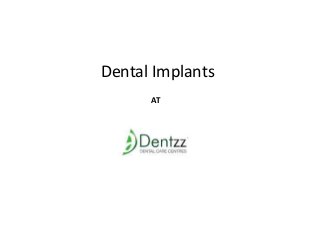 Dental Implants
AT
 
