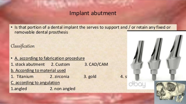 implants abutment