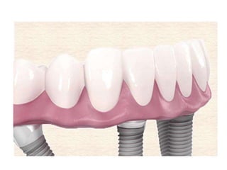 Dental Implant Thailand