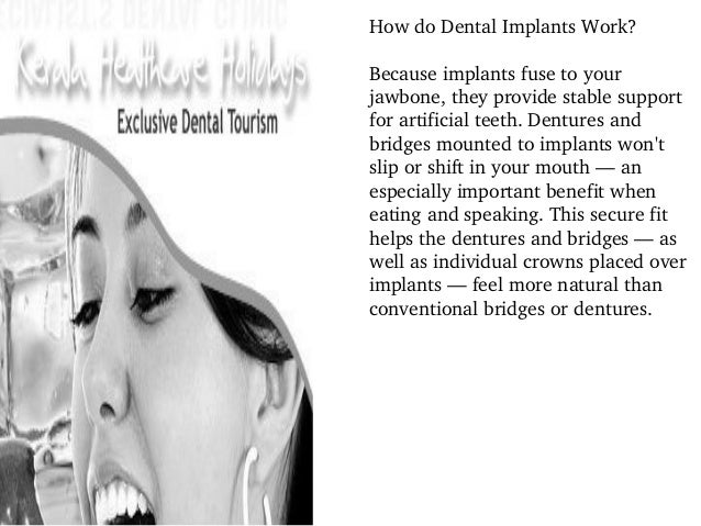 Dental implant treatment