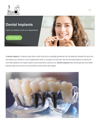 Dental Implants
Call to our dentist to book your appointment
Call Us Now!
A dental implant is a titanium post (like a tooth root) that is surgically positioned into the jawbone beneath the gum line
that allows your dentist to mount replacement teeth or a bridge into that area. We are serving Auckland as well as all
over New Zealand. An implant doesn’t come loose like a denture can. Dental implants also benefit general oral health
because they do not have to be anchored to other teeth, like bridges.
 09 626 5205
 