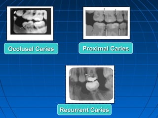 Occlusal Caries          Proximal Caries




                  Recurrent Caries
 