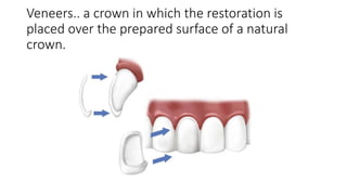 Veneers.. a crown in which the restoration is
placed over the prepared surface of a natural
crown.
 