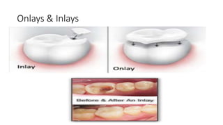 Onlays & Inlays
 
