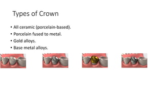 Types of Crown
• All ceramic (porcelain-based).
• Porcelain fused to metal.
• Gold alloys.
• Base metal alloys.
 