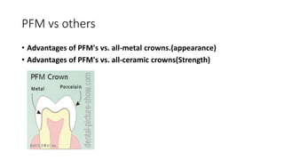 PFM vs others
• Advantages of PFM's vs. all-metal crowns.(appearance)
• Advantages of PFM's vs. all-ceramic crowns(Strength)
 