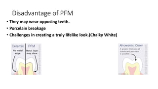 Disadvantage of PFM
• They may wear opposing teeth.
• Porcelain breakage
• Challenges in creating a truly lifelike look.(Chalky White)
 