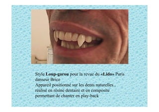 Style Loup-garou pour la revue du «Lido» Paris
danseur Brice
Appareil positionné sur les dents naturelles ,
réalisé en rés...