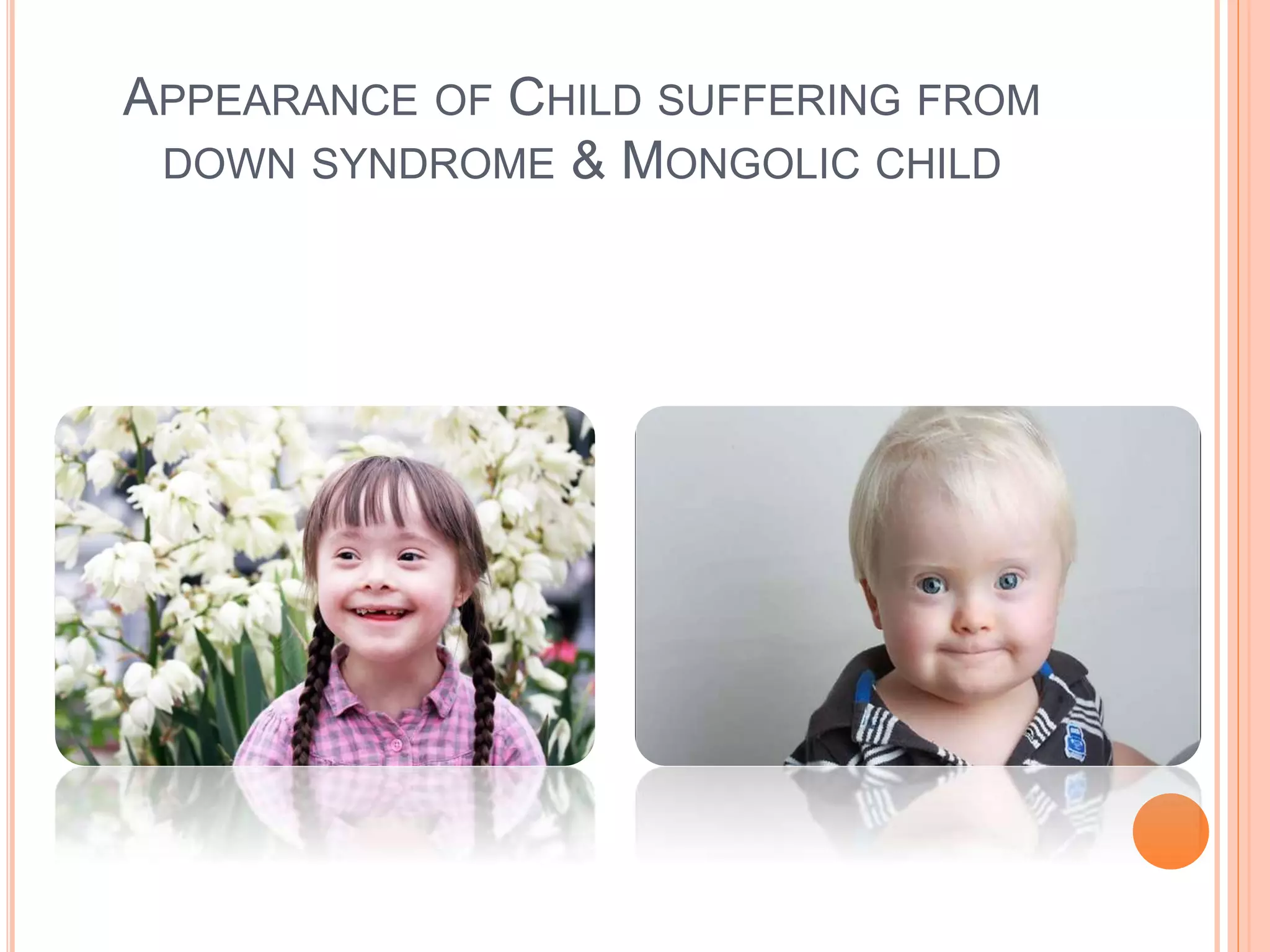Dental management downs syndrome, fetal alcohol syndrome | PPTX