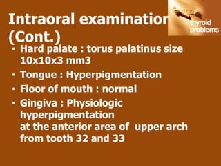 Intraoral examination
(Cont.)
• Hard palate : torus palatinus size
  10x10x3 mm3
• Tongue : Hyperpigmentation
• Floor of mouth : normal
• Gingiva : Physiologic
  hyperpigmentation
  at the anterior area of upper arch
  from tooth 32 and 33
 