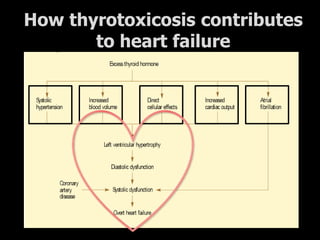 How thyrotoxicosis contributes
       to heart failure
 