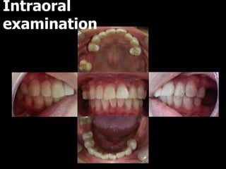 Intraoral
examination
 