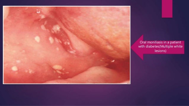 r blood glu test diabetic management of a patient Dental