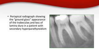 Glass Radiograph Dental Management of Chronic Renal Failure and Dialysis.pptx
