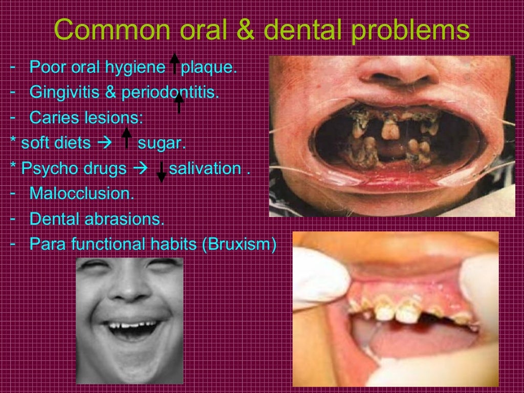 Dental management of handicapped children