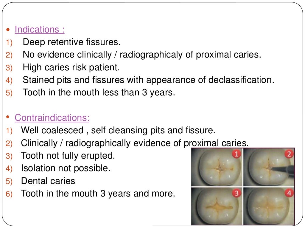 Dental restorative material in pediatric dentistry