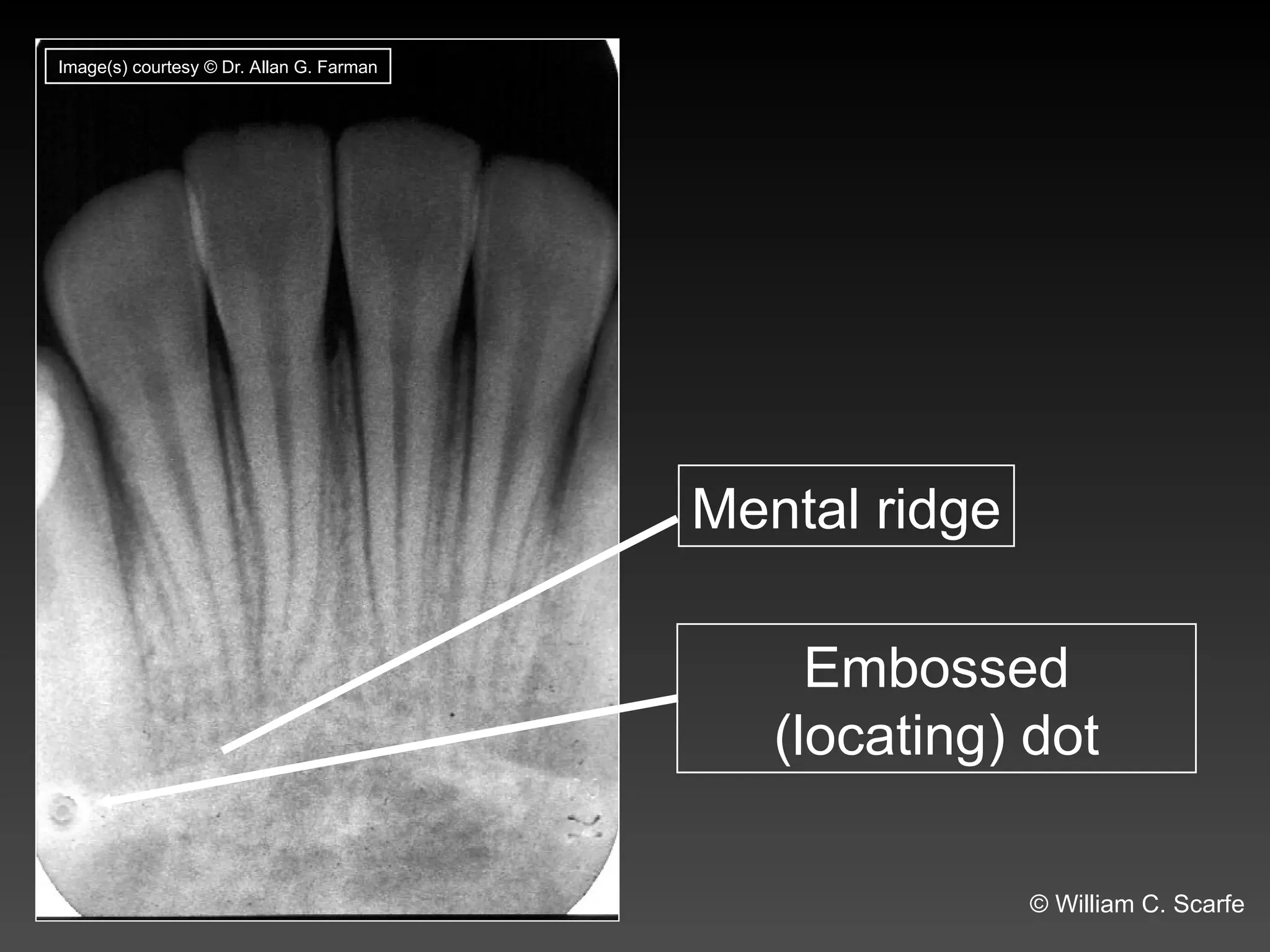 Flabby Ridge Radiograph Dental Maxillary and Mandibular Anatomic Radiographic Landmarks.ppt