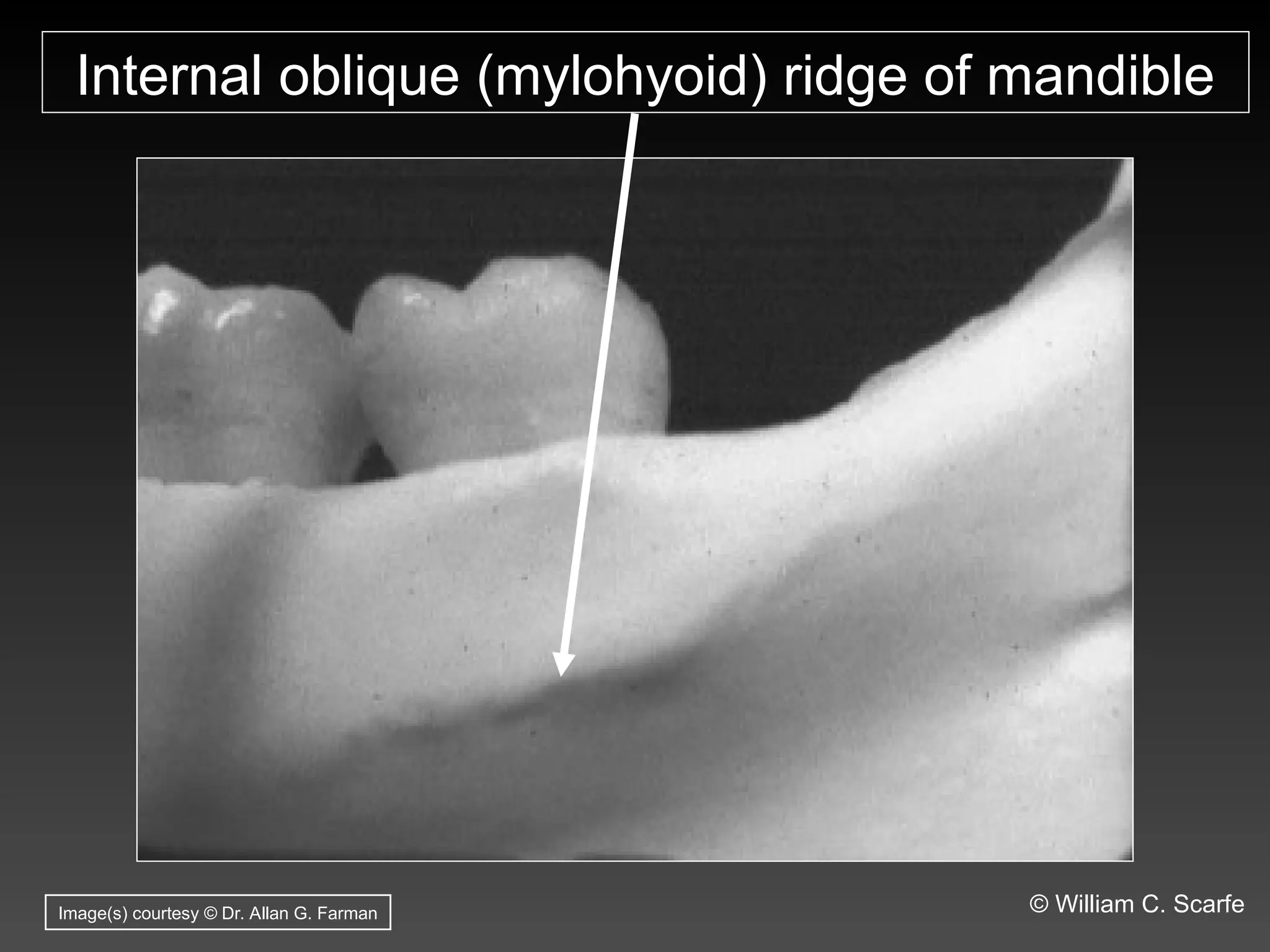 Dental Maxillary and Mandibular Anatomic Radiographic Landmarks.ppt