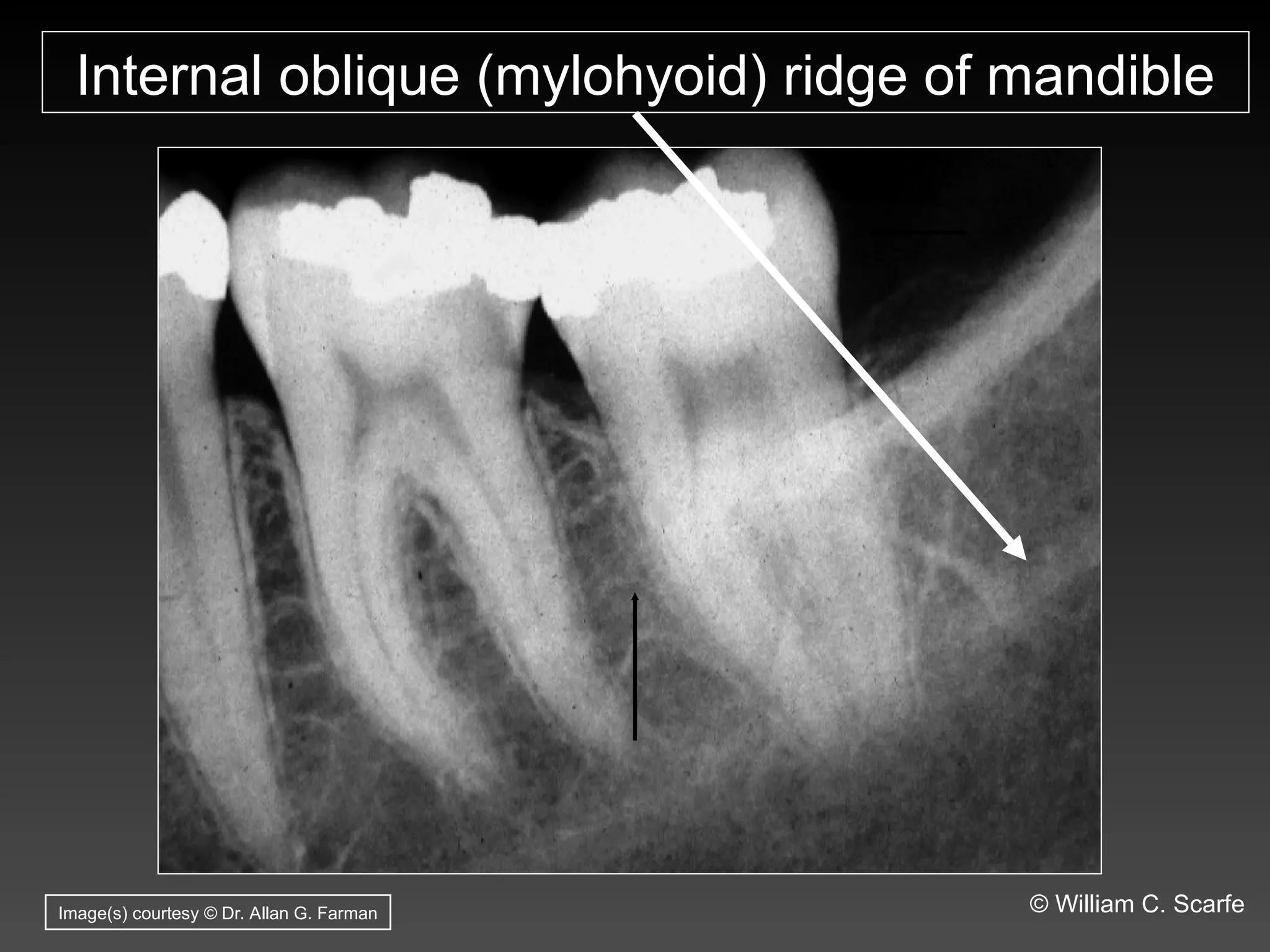 Dental Maxillary and Mandibular Anatomic Radiographic Landmarks.ppt