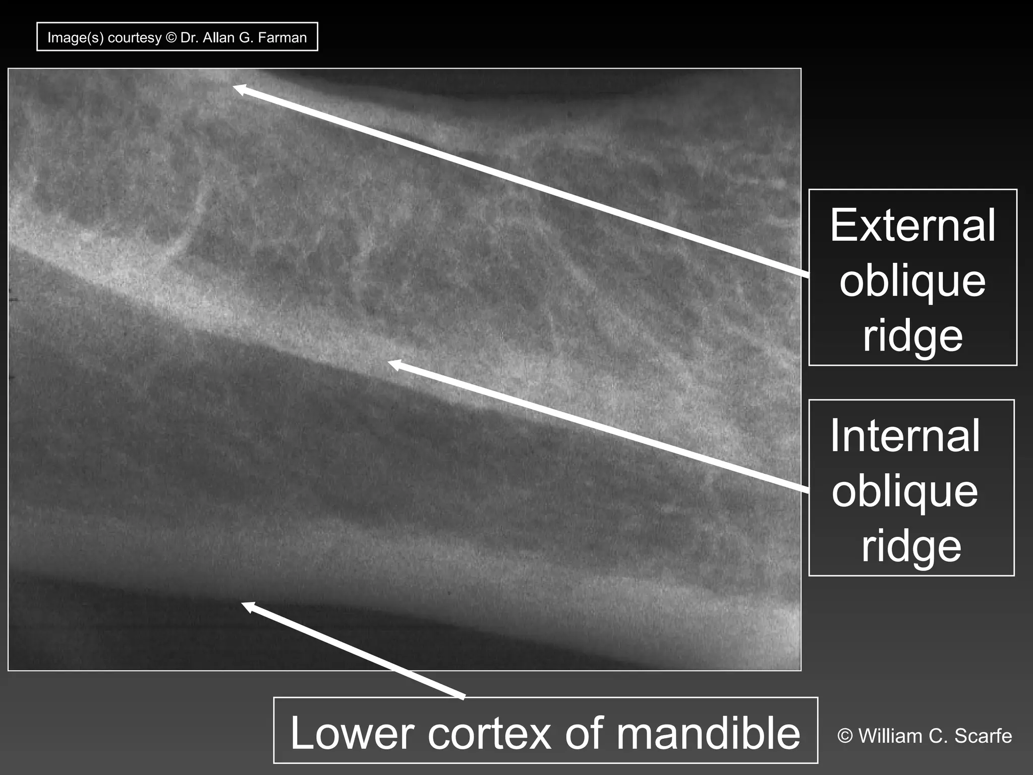 Dental Maxillary and Mandibular Anatomic Radiographic Landmarks.ppt