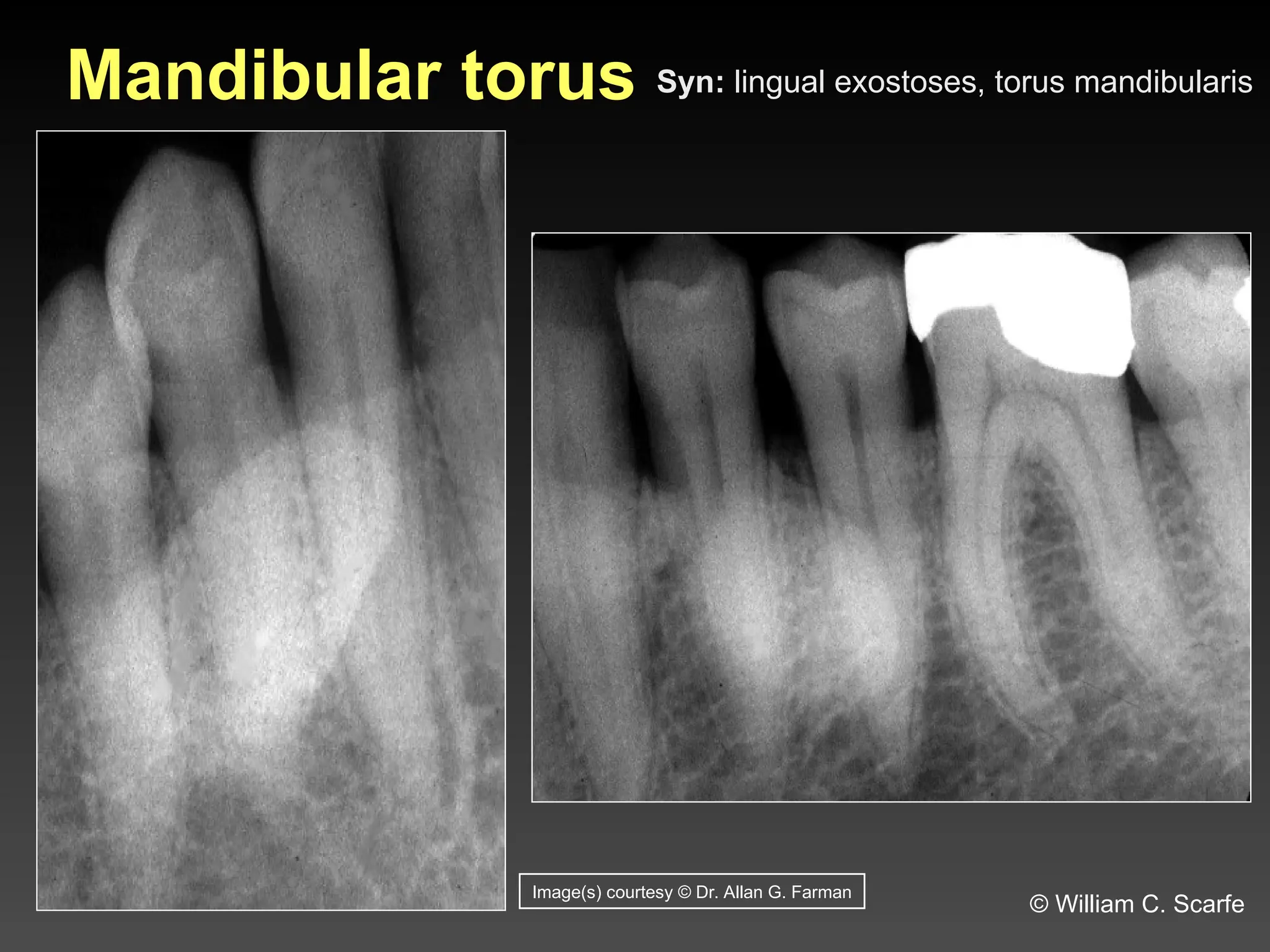 Dental Maxillary and Mandibular Anatomic Radiographic Landmarks.ppt