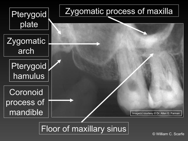 Dental Maxillary and Mandibular Anatomic Radiographic Landmarks.ppt | 3 ...