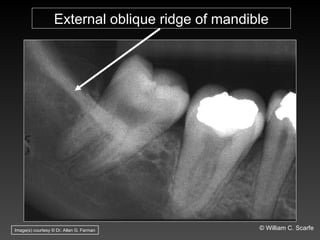 Oblique Ridge Radiography Dental Maxillary and Mandibular Anatomic Radiographic Landmarks.ppt