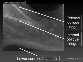 Oblique Ridge Invisalign Dental Maxillary and Mandibular Anatomic Radiographic Landmarks.ppt