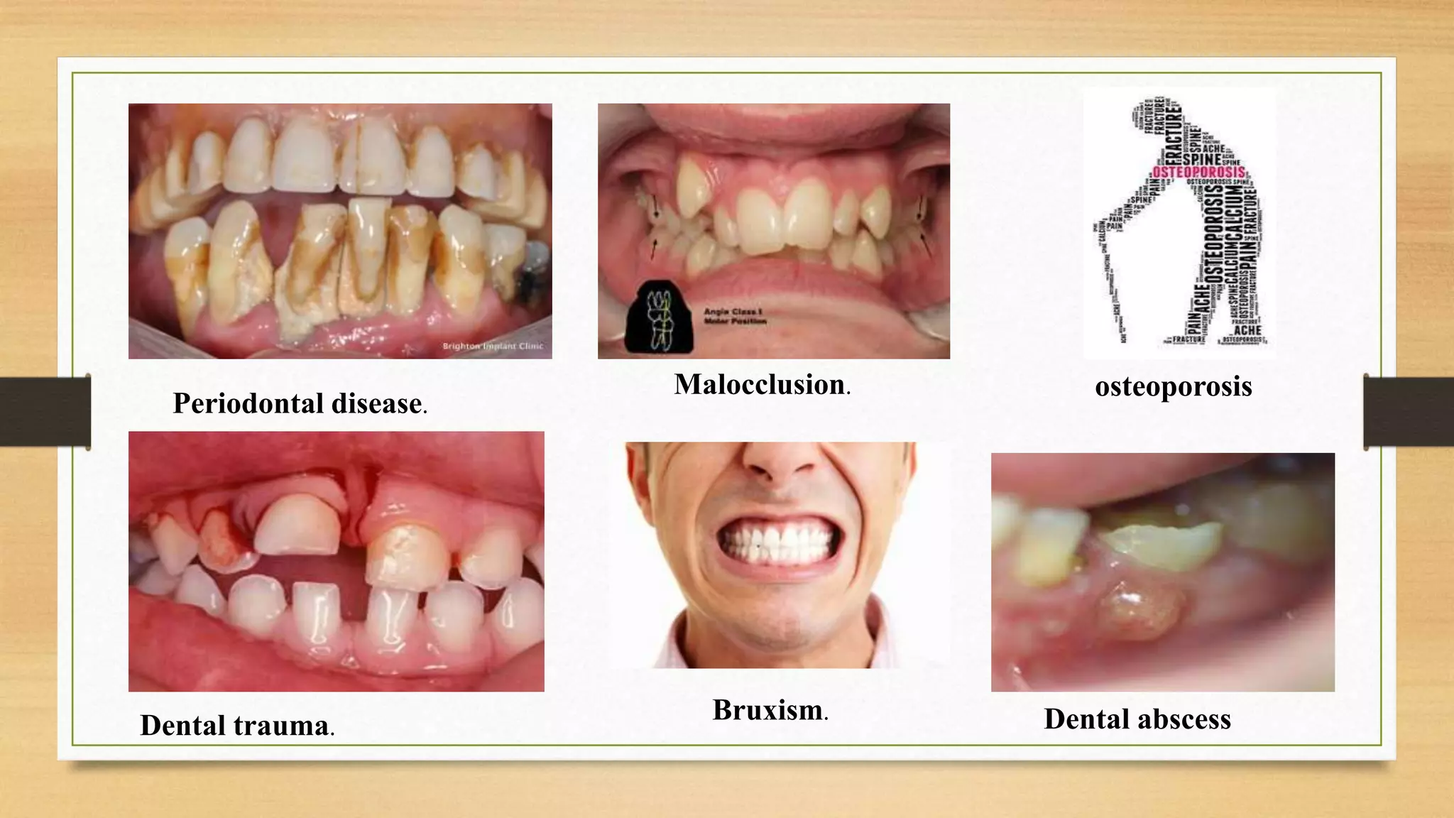 Dental mobility | PPTX