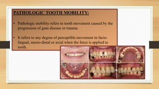 Dental mobility | PPTX