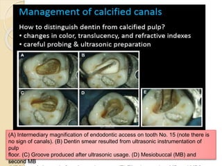 (A) Intermediary magnification of endodontic access on tooth No. 15 (note there is
no sign of canals). (B) Dentin smear resulted from ultrasonic instrumentation of
pulp
floor. (C) Groove produced after ultrasonic usage. (D) Mesiobuccal (MB) and
second MB
 
